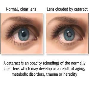cataracts